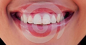 Woman, lips and teeth whitening with veneers for dental closeup, smile and happiness on face for health. Orthodontics