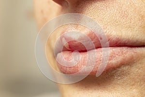 woman lips with a virus herpes pustule, manifestation of herpes, photo