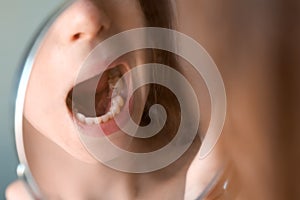 Woman is looking at mirror on removed sixth tooth on which suture is applied.