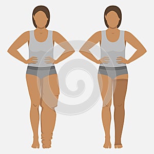 Woman with Lymphedema in Medical Compression Stocking