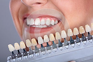 Woman Matching Shade Of The Implant Teeth