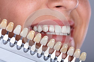 Woman Matching Shade Of The Implant Teeth
