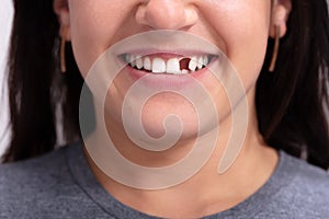 Woman With Missing Tooth