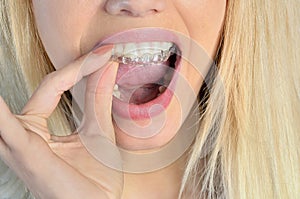 Woman with mouthguard