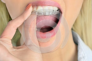 Woman with mouthguard photo