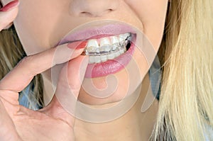 Woman with mouthguard photo