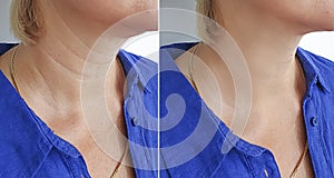 Woman neck wrinkles before  after treatment