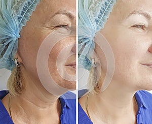 Woman neck wrinkles facelift  before after treatment removal photo