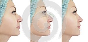 Woman nose correction before and after procedures, hump profile