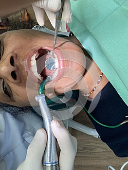 Woman with open mouth treating teeth with