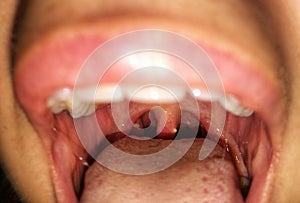 Woman with open mouth. Zooming closeup view of plaques with pus on tonsils gland in both sides photo