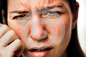 Woman with painful hot sunburn,facial skin redness problem,photosensitivity.Chemical burn,allergic reaction.Rosacea,dermatological photo