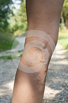 Woman with painful, swollen varicose veins resting on a walk through nature
