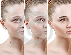 Woman with phase of skin rejuvenation before and after treatment.