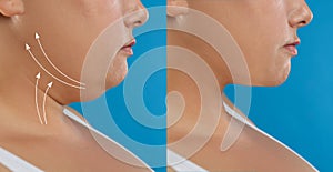 Woman before and after plastic surgery  on blue background, closeup. Double chin problem