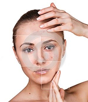 Woman with problem skin on her face