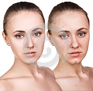 Woman with problem skin on her face