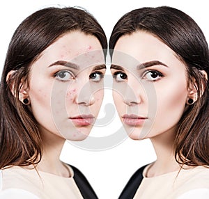 Woman with problem skin on her face