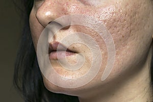 Woman with problematic skin and acne scars. Pigmentation on face woman. Problem skin care and health concept.