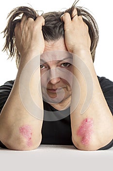 Woman with psoriasis