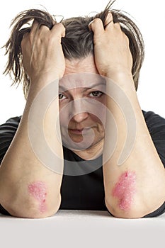 Woman with psoriasis photo