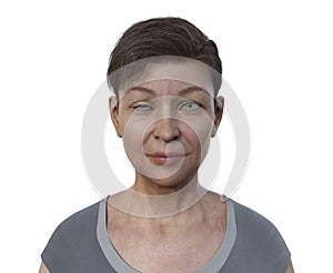 A woman with ptosis, 3D illustration