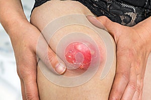 Woman pushing skin of the leg - cellulite problem