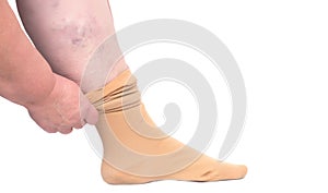 Woman putting on the leg medical stocking for varicose veins on the legs, white background, isolate, close-up, phlebeurysm