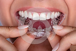 Woman Putting Transparent Aligner In Teeth