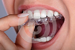 Woman Putting Transparent Aligner In Teeth