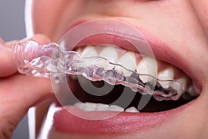 Woman Putting Transparent Aligner In Teeth