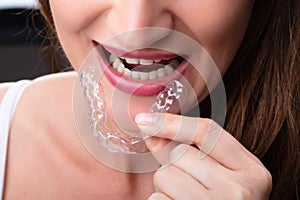 Woman Putting Transparent Aligner In Teeth