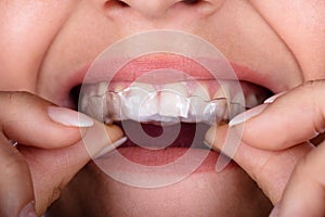 Woman Putting Transparent Aligner In Teeth