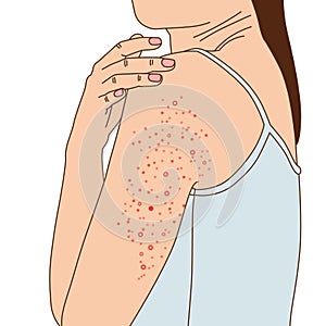A woman with a rash on her upper arm. The rash is red and itchy. Illustration on white background
