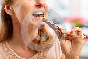 Woman with rash and reddening neck eating chocolate bar