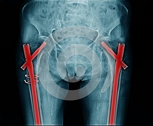 Woman x-ray image show fixation device