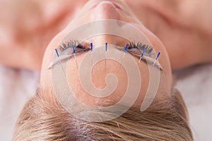 Woman receiving an acupuncture needle therapy