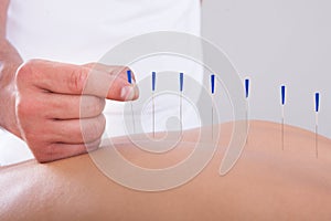 Woman receiving an acupuncture therapy