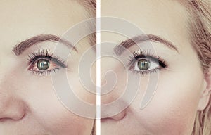 Woman red eye before and after procedures ophthalmology