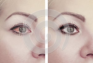 Woman red eye before after threat vision problem procedures ophthalmology