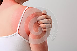 Woman with red sunburned skin against light background, closeup