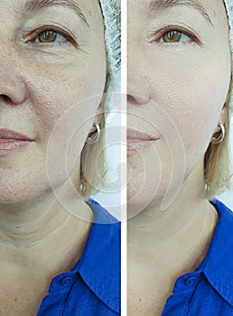 Woman removal wrinkles rejuvenation difference  regeneration  result before therapy correction after treatment