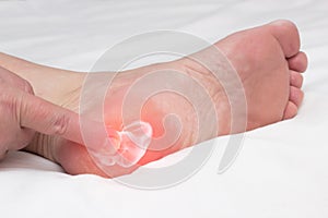 A woman rubs a healing balm cream for the treatment of thorns and osteophytes, a spot spur in the heel, removal of inflammation photo