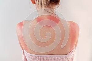 Woman`s back skin hurt from sun burn.