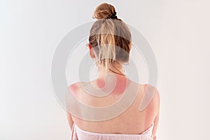 Woman`s back skin hurt from sun burn.