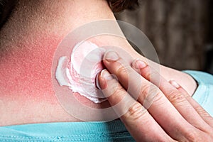 On woman`s back skin smears cream after sun burn