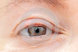 Woman`s eye with a bacterial infection