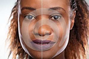 Woman`s Face Before And After Cosmetic Procedure
