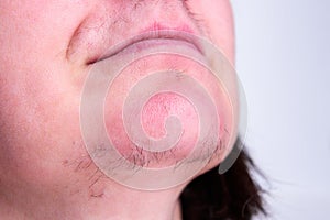 Woman\'s face with moustache and hairs on chin.