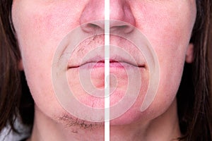 Woman's face with moustache and hairs on chin. Before and after hair removal and epilation.